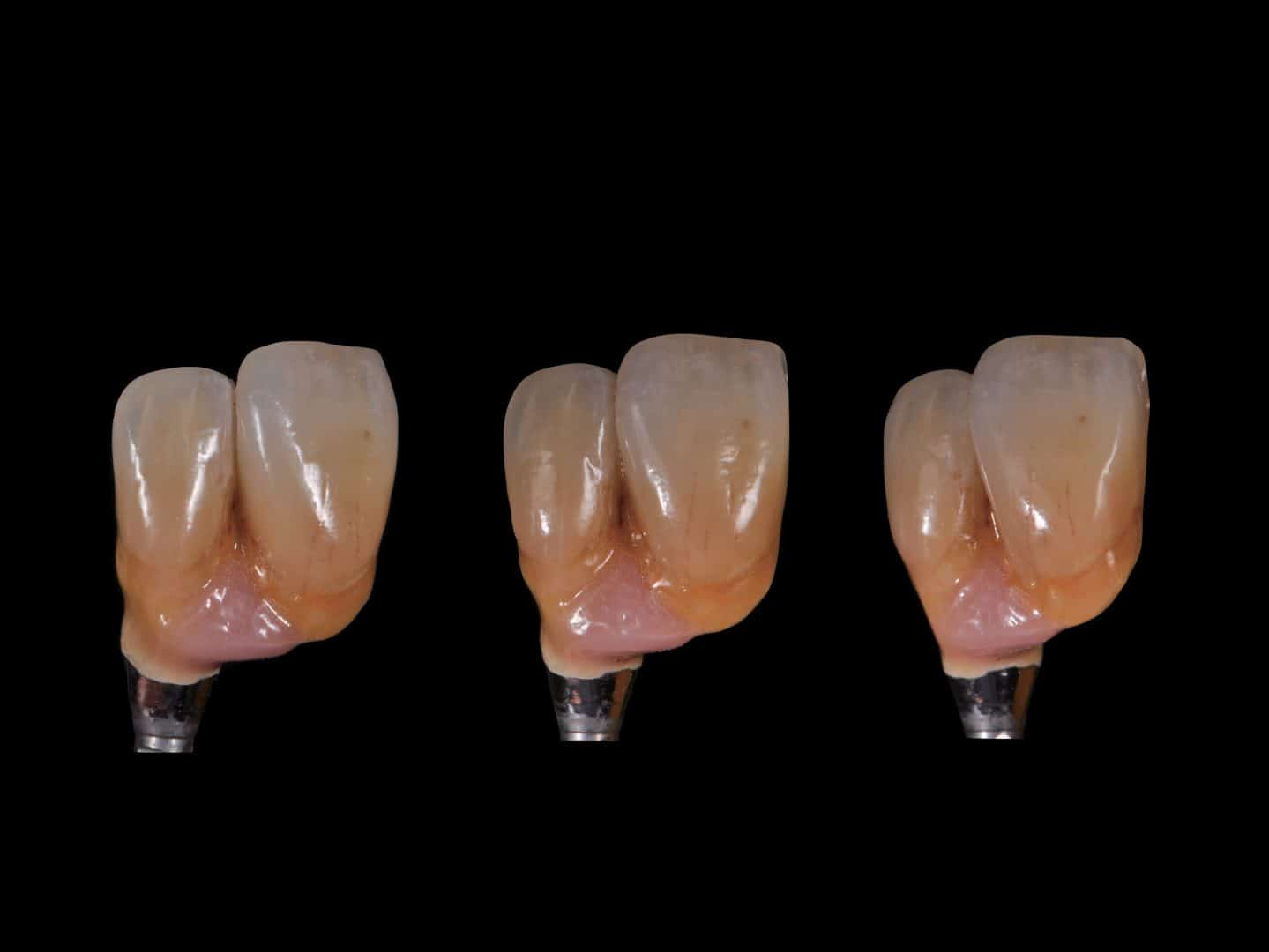 digital dental implants dentist christchurch boutique dental