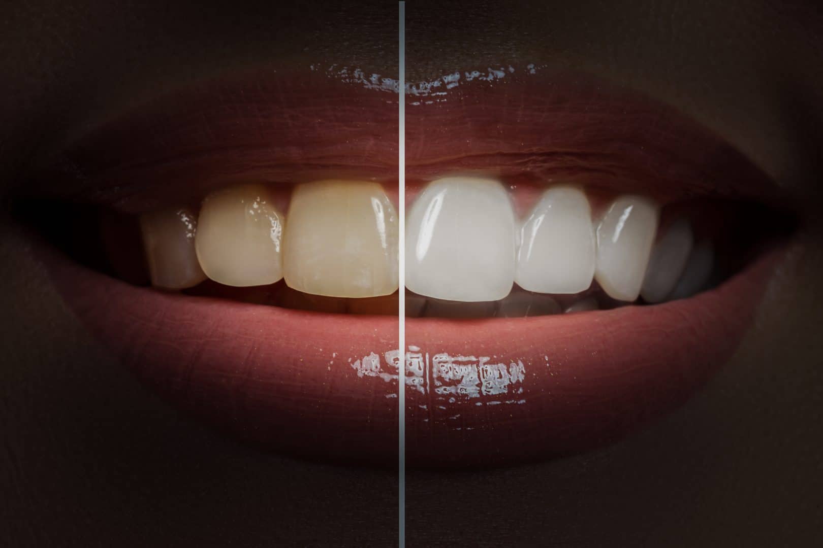 christchurch dentist teeth whitening